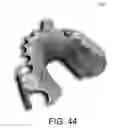Fig. 41 - SYSTEMS FOR DENTURE PREPARATION