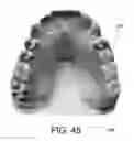Fig. 42 - SYSTEMS FOR DENTURE PREPARATION
