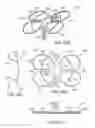 Fig. 25 - Apparatus and methods for treating sleep apnea