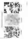 Fig. 03 - DIAGNOSIS AND TREATMENT OF NEUROECTODERMAL TUMORS