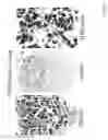 Fig. 08 - DIAGNOSIS AND TREATMENT OF NEUROECTODERMAL TUMORS
