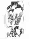 Fig. 12 - DIAGNOSIS AND TREATMENT OF NEUROECTODERMAL TUMORS