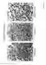 Fig. 13 - DIAGNOSIS AND TREATMENT OF NEUROECTODERMAL TUMORS