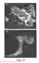 Fig. 18 - COMPOSITIONS AND METHODS COMPRISING VEGFR-2 AND VEGFR-3 ANTAGONISTS FOR THE TREATMENT OF METASTATIC DISEASE