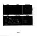Fig. 03 - Bioassay for the early detection of autoimmune diseases