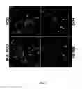 Fig. 04 - Bioassay for the early detection of autoimmune diseases