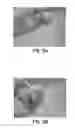 Fig. 05 - Method of obtaining viable small tissue particles and use for tissue repair