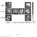 Fig. 02 - Synergistic combinations to reduce particle dose for targeted treatment of cancer and its metastases