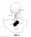 Fig. 04 - POM POM Device