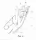 Fig. 12 - Orthodontic bracket with a pad
