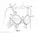 Fig. 02 - Breast enhancing brassiere