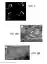 Fig. 05 - Enhancement of bone morphogenic protein (BMP) retention with BMP binding peptide (BBP)
