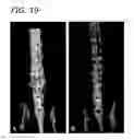 Fig. 13 - Enhancement of bone morphogenic protein (BMP) retention with BMP binding peptide (BBP)