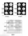 Fig. 08 - Molecular diagnostic methods for predicting brain metastasis of breast cancer