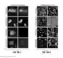 Fig. 15 - Molecular diagnostic methods for predicting brain metastasis of breast cancer