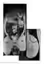 Fig. 07 - MULTIMODAL VISIBLE POLYMER EMBOLIZATION MATERIAL
