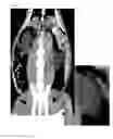 Fig. 08 - MULTIMODAL VISIBLE POLYMER EMBOLIZATION MATERIAL