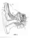 Fig. 02 - Insertion system for inserting implantable electrode carrier