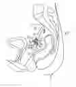 Fig. 01 - Vaginal vault suspension device and method
