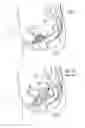 Fig. 02 - Vaginal vault suspension device and method