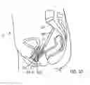 Fig. 06 - Vaginal vault suspension device and method
