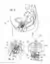 Fig. 07 - Vaginal vault suspension device and method