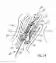 Fig. 08 - Vaginal vault suspension device and method