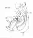 Fig. 09 - Vaginal vault suspension device and method