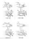 Fig. 70 - Devices and methods for tissue modification