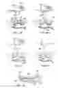 Fig. 75 - Devices and methods for tissue modification