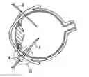 Fig. 01 - SELF-LOCKING CANNULA