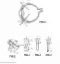Fig. 02 - SELF-LOCKING CANNULA