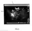 Fig. 04 - Method, an optical probe and a confocal microscopy system for inspecting a solid organ