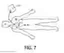Fig. 09 - ULTRASONIC VASCULAR FLOW SENSOR WITH TRIANGULAR SENSOR GEOMETRY