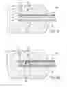 Fig. 14 - METHODS AND DEVICES FOR REMOVING TISSUE FROM A PATIENT AND PLACING A MARKER IN THE PATIENT