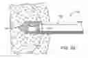 Fig. 20 - METHODS AND DEVICES FOR REMOVING TISSUE FROM A PATIENT AND PLACING A MARKER IN THE PATIENT