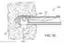 Fig. 21 - METHODS AND DEVICES FOR REMOVING TISSUE FROM A PATIENT AND PLACING A MARKER IN THE PATIENT