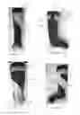 Fig. 03 - Orthotic device and method