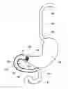 Fig. 01 - Anchors and methods for intestinal bypass sleeves