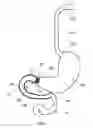 Fig. 02 - Anchors and methods for intestinal bypass sleeves