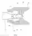 Fig. 44 - Anchors and methods for intestinal bypass sleeves