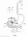 Fig. 69 - Anchors and methods for intestinal bypass sleeves