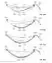 Fig. 14 - Catheter access and control device and method of using same