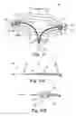 Fig. 10 - LOW-PROFILE OFF-WALL ELECTRODE DEVICE FOR RENAL NERVE ABLATION