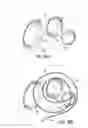 Fig. 11 - Systems, devices and methods for treating the heart with ablation