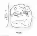 Fig. 21 - Systems, devices and methods for treating the heart with ablation