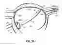 Fig. 27 - Systems, devices and methods for treating the heart with ablation
