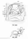 Fig. 39 - Systems, devices and methods for treating the heart with ablation
