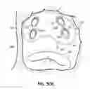 Fig. 41 - Systems, devices and methods for treating the heart with ablation