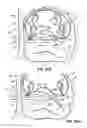 Fig. 42 - Systems, devices and methods for treating the heart with ablation